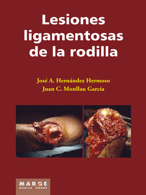 cover image of Lesiones ligamentosas de la rodilla